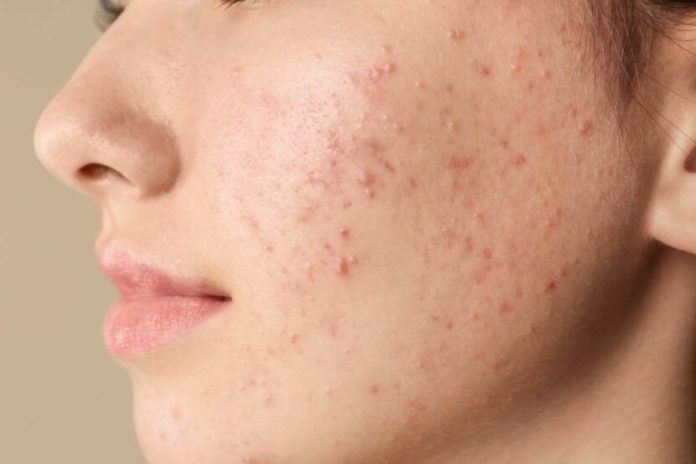 La nostra peggior nemica? L’acne. I consigli della dermatologa per curarla - Ragazzamoderna.it